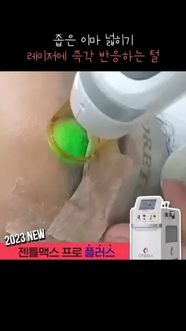#헤어라인제모  #리뉴미피부과동대문  좁은 이마 탈출하는 비법! 바로 <레이저 제모> 시술에 사용된 #젠틀맥스프로플러스 는 23년 최신형 레이저로 통증은 낮추고, 효과는 더 높인 프리미엄 레이저 입니다 :) #젠틀맥스제모  #뒷목  #뒷목헤어라인  #뒷목왁싱  #뒷목헤어라인왁싱  #제모레이저  #제모  #여자제모  #인중제모  #헤어라인  #헤어라인제모  #손가락제모  #겨드랑이제모  #턱수염제모  #수염제모