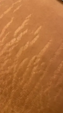Bij striae wordt een onderscheid gemaakt tussen twee soorten striae; striae rubra (rode striae) en striae alba (witte striae).   Striae rubra zijn rood en hebben een grillig uiterlijk. Deze variant kan uiteindelijk overgaan in witte ongepigmenteerde lijnen en deze striae alba zijn permanent. Belangrijk om te weten is dat striae rubra beter te behandelen is dan striae alba. Striae rubra Striae rubra is verse striae die meteen ontstaat na snelle groei of het krimpen van de huid. Rood, paars, blauw of donkerbruin.  Striae alba Na verloop van tijd verlittekenen deze strepen en worden ze veel lichter van kleur, wit of zilver of lichtbruin bij de donkere huid.  Striae alba ontstaat in de tussentijd vanuit striae rubra.  Na 6 maanden tot 1,5 jaar verandert de striae van rubra naar alba in de meeste gevallen maar dit kan bij sommigen ook enkele jaren duren.  Hoe herken je beginnende striae? Beginnende striemen herken je vaak als eerst aan jeuk: je huid begint te jeuken op plekken waar het aan het groeien is. Vervolgens kun je paarse en rode verkleuringen in de huid zien. Deze verkleuringen zijn littekens die onder je huid (in je bindweefsel) zitten. Hoe werkt deze behandeling?   Doormidel van op een bepaalde manier zacht met een naaldmodule door de striae heen te gaan met een mix van serums, biologische oliën en vitamines zorgen we ervoor de dat de huid weer zal herstellen. Deze naaldmodule maakt in de huid minuscule gaatjes waar het serum zijn werk kan doen. Er wordt een sterke wondgenezing gecreëerd in de huidlaag waardoor deze kleine gaatjes zich opvullen met nieuw, gezond huidweefsel. Omdat de omliggende opperhuid zo veel mogelijk intact is gebleven, kunnen deze cellen het huidherstel nog meer bespoedigen. De behandeling die IKIGAI aanbiedt zorgt voor: - Vermindering van striae - Huidverstrakking - Verbetering van de huidtextuur - Verbetering van de ongelijkmatige teint Vragen? Voor meer informatie: (06) 21 43 44 65 info@ikigai.amsterdam #striae #stretchmarks #stretchmarkremoval #inklessstretchmarksremoval #stretchmark #collagen