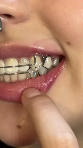 A lot of people (only 1 person) ask me if they can get tooth gems if they wear metal retainers and the answer is yes!! ✨ Placement is very important as it should never interfere with the metal retainer. For that reason we did gems on the canines and lateral 🥶🧊🌪️ . #toothgem #toothgems #dallastoothgems #toothgemsdallas #dallastx #oakcliffbidness #teethgems #teethjewelry #toothjewelry #teethgem 