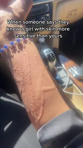 Sensitive skin girlies #dermatographiacheck #sensitiveskin 