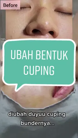 #ubahbentukcuping #nostrilexcision #potongcuping #ngecilincuping #ngecilinhidung