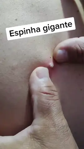 Part 1 #acne #pimple #satisfying #satisfatório #satisfatorio #asmr #foryou #relax #cravos #cravogigante #espinha #espinhagigante