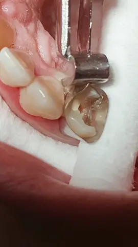 composite restoration after RCT #dentist #dentista #dentistry #fyp #tiktoklongs 