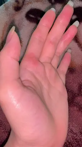 12h đêm mới được nghỉ kh biết có dầu kh mà em phồng tay như này 😭😭#xuhuongtiktok #BookTok 