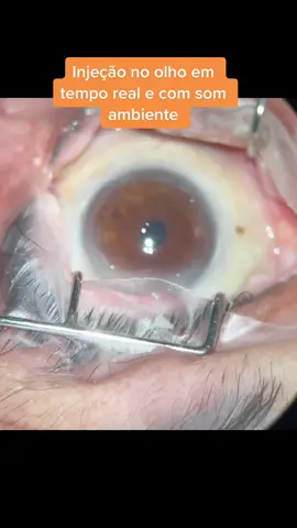 Nao deixe de fazer por medo. É muito tranquilo, seguro e pode salvar muitas visoes. #oftalmologista #oftalmologia #drjoaopaulolomelino #retina #injecao 
