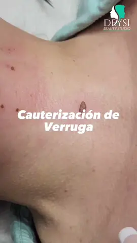 verrugas #salud #colorado #fyp #woman #coloradosprings #verrugas #warts 