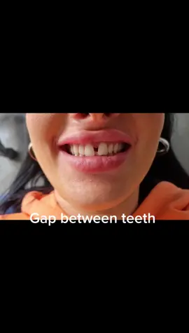 Using composite bonding to close the gap between teeth 😬 😊. Our lovely patient, Sharon, was ove the moon with her results. No 💉 No drilling and a happy patient 😊🫠🥳#lookingyoung #lookingafterteeth #mayparkdental #malahidevillage #ireland #smile #smilemakeover #dentist #compositebonding 