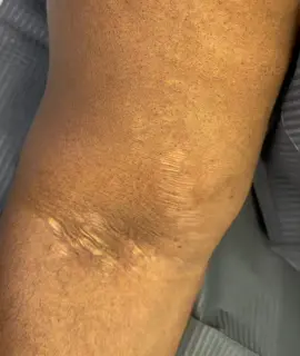 Stretchmark Revision #stretchmarks #stretchmarkremoval #stretchmarkremedy #stretchmarksremoveremedy #antistretchmark #treatstretchmarks #dmv 