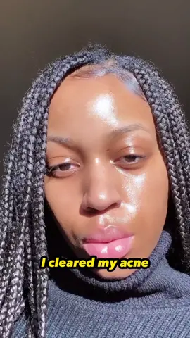 Acne Journey 🥹 I made it on the other side abd you can too! ❤️ #acne#skincare#clearskin
