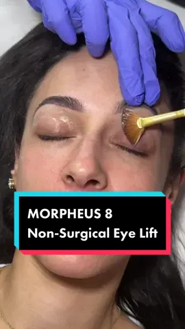 Morpheus 8 for a NON-SURGICAL eye lift. Stay tuned for the transformation👏🏼 #morpheus8 #morpheus8treatment #nonsurgical #nonsurgicaleyebrowlift #noninvasive #skintransformation 