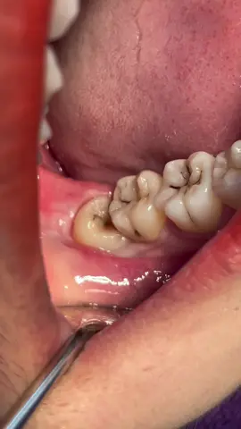 Răng khôn mọc lệch .. gây dắt thức ăn .. sâu răng 7 kế bên .. hôi miệng ..! Xử lý nhẹ nhàng cho khách …!! Lễ 30/4 #răngkhôn 
