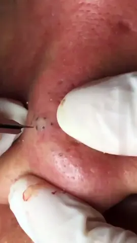 #428 Check Bio for full video #relax every day #acne #squeeze #blackheads #acnetreatment #pimple #pimplepopping #squeezeacne #pimplepop #blackhead #acneremoval 