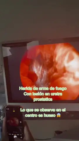 Heridas impactantes :/ #medicina #urologia #consulta #viraltiktok 