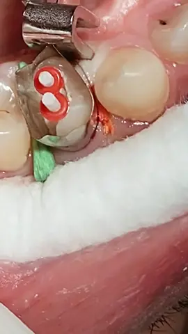 composite restoration with fiber post #dentist #dentista #dental #composite #fyp 