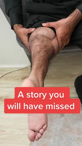 A story you will have missed! This man had his foot sewn on backwards after a life saving amputation #dailymirror #LearnOnTikTok #fyp 