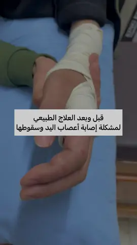 نتيجة العلاج الطبيعى بعد إصابة لجميع أعصاب اليد وسقوطها وفقدان جميع الحركات بها🫲 تمت إستعادة جميع حركات مفصل الرسغ والأصابع بعد شهرين ونصف فقط من العلاج الطبيعى💪💪  #دكتوره_نهال_فتحى  #fypシ  #fyp  #تراست_كلينك  #علاج_طبيعي  #hand  #wrist  #physiotherapy  #اكسبلورexplore  #viral 