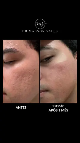 ✨Antes x Depois✨ Percebam a melhora espetacular nas cicatrizes de acne da pele, com apenas uma sessão. Se você é novo aqui no perfil, seja bem-vindo (a)! #peeling #peelingquimico #fenol #skin #medico #fy #medicina #antesdepois #estetica #beleza #cicatrizesdeacne #esteticista #dermatologia #reidofenol #phenolgold 