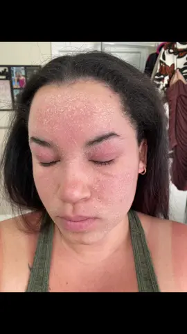 OBSESSED over this skincare is an understatement! I literally could cry at how amazing these products have transformed my skin. From someone who has tried just about EVERYTHING to clear my eczema/contact dermatitis, this is GOLD. 10/10 recommend. This was a 10 day difference 🙌🏼 @byoma #eczemaflareup #eczemahealing #fyp #byomaskincare #byoma4betterskin #skincareroutine 