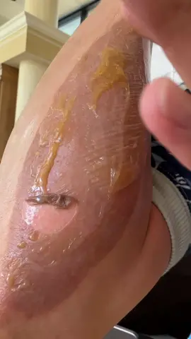 Rubbing honey into my burn. This was the 2nd day. Currently on day 5 