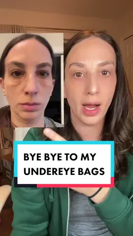 BYE BYE TO MY UNDEREYE BAGS - no makeup or filters on my face #undereyebagsolution #undereyebags #xanthelasma #byebyeundereyebags #itcosmetics #undereyecream #eyetightener #smoothundereyes #over40skincaretips  #itcosmeticsgiftedme @IT Cosmetics  