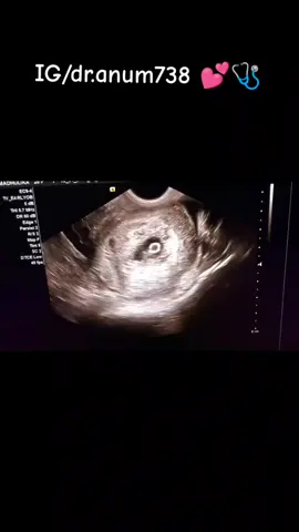 ✨#ultrasound #ultrasoundvideo #foryou #foryoupage #dranum #doctoranum #anum_aqib #cocomochillimilli #anumaqibbangash #viral #peshawar #gynecologist 