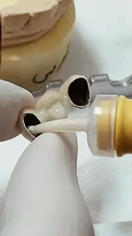 PFM bridge cementation #dentist #dentista #dental #dentistry #fyp #foryoupage #viral 