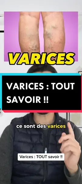 Varices : TOUR savoir !! #tiktokacademie #sante #varices #sang #varice #medical #medecine #science #maladie #education #prevention 