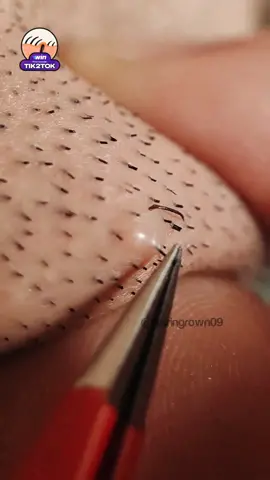 #extraction #satisfyingvideo #satisfying #ingrownhairpull #tweezer #ingrownhair #skincare 