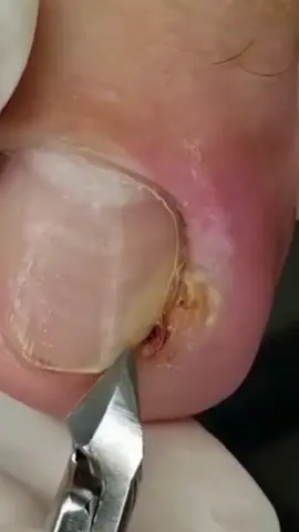 muito satisfatório 🥵 #vocênasceuparamudar #satisfyingvideo #foryoupage #fy #fyp #fypシ #relaxante #unhasencravadas #encravada #podologia #podologa #podologo 
