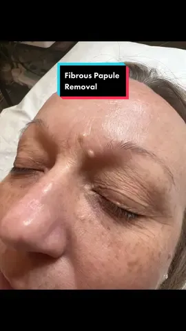 Advanced electrolysis to remove fibrous papules. Before and straight after treatment. Looking forward to seeing the results when fully healed #bondgirls #blemishremoval #northampton #advancedelectrolysis #charliesangels #007 #blemish #removal #bosslady #removals #fibrouspapule #skin #bossit #skinspecialist #cosmeticprocedures 