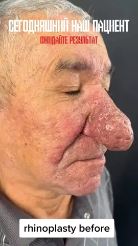 rhinoplasty #rhinoplasty #nosejob #beforeandafterrhinoplasty #belpharoplasty 