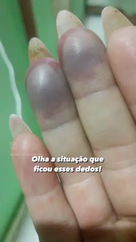20 kilos caiu em cima dos dedos na academia !😰😳#unhasdegel #vidadenailsdesigner 