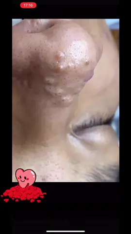 BAJO 🔍 LUPA 🔍 SI TE GUSTAN DEJA TUS COMENTARIOS #extraction #puntosnegros #espinillas #acne #grasa#poros#espinillas 