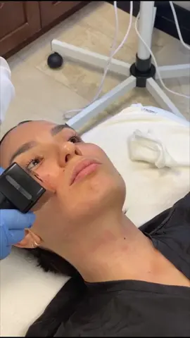 My first #Morpheus8 session with @Miami Plastic Surgery® with Maylen Cadenas! Im loving my results! #miamiplasticsurgery #miamiskincare #skincare #skincaretips #microneedling #radiofrequency 