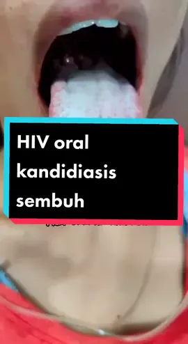 HIV oral kandidiasis sembuh 5 hari dengan pemberian Nystatin drop#hiv#aidsawareness#aids#oralkandidiasis#hivaids#hivpositive#dokterparu#spesialisparu#dokterviral#spesialisparumedan#foryourpage#foryou#fypシ゚#fyp 