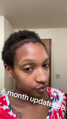 6 month hair transplant update ❤️ #hairtransplant #Longevita #alopecia #fuehairtransplant #blackwomen #hairgrowth 