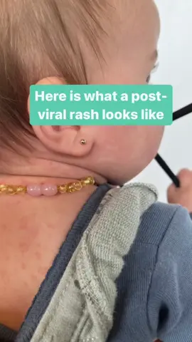 Well that illness I shared on last week's reel ended up definitely being a virus and then, 24 hours after the fever broke we had a viral rash!  Guess what…. This is NORMAL and often to be expected after a child has a virus. And guess what again? 💗I am not worried AT ALL and I don’t want you to be either! Post viral rashes are VERY common.  The rash arrives toward the end of the infection and lasts a couple of days.  It's the body's reaction to the virus and doesn't respond to much medication, including steroids.  🌟IT WILL GO AWAY WITHOUT NEED OF TREATMENT! 🌟 The body is so wise. Unlike an allergic reaction, viral rashes usually do not cause itching or pain. Viral rashes often go away after a few days. But they may last up to 2 weeks.  There are 5 viral infections that can lead to a rash -chickenpox (varicella) -fifth disease -measles (rubeola) -roseola -rubella (German measles). The most common we see today are: ➡️Fifths disease  → rash will be on the cheeks ➡️Roseola → rash will start on chest and stomach and can move to the neck, face, and arms See the photos of my baby she had Roseola since it was a body wide rash.  And do you see her BIG SMILE?! 💗   Although during the day she was happy, don't be fooled; the nights with fever had her feeling pretty uncomfortable.  After 24 hours she is back to her happy self and this rash doesn’t bother her a bit. And as a Doctor Mom it doesn’t bother me either.  I expected it and I want you to as well. Stay calm Doctor Mom! I will cover more in depth viral rashes inside my Doctor Mom membership soon, I'm going in the list of order based on popularity.  💗I always love asking what you moms want to learn and I am happy to share my natural medicine protocols to make life easy for you when your child get’s sick.  Share this with a friend who can learn from this post! #viralrash #kidshealth #holisticwellness #naturopathicdoctor #momlifevibes #momlifeiscrazy 