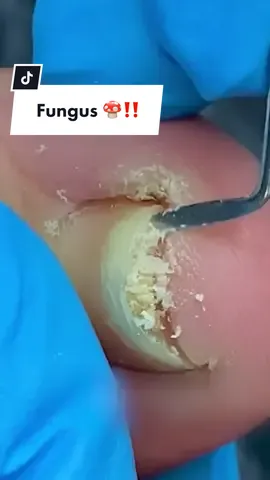 The fungus has been confirmed 😲 #nails #fungus #treatment #podologia 