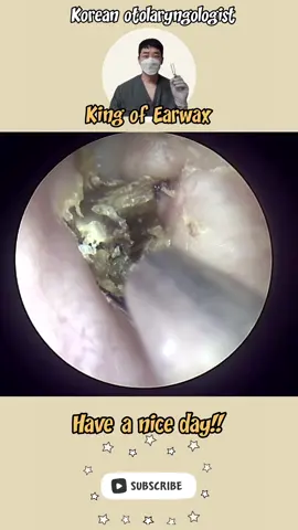@귀지형 #귀지#귀지제거 #귀파기 #귀파기asmr  #귀청소 #이비인후과 #earwax #earwaxremoval  #asmr