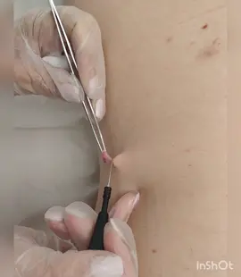 Así extirpamos un fibroma péndulo 👩🏼‍⚕️ Los fibromas péndulos, son tumores benignos que conviene quitar cuando adquieren un tamaño grande, ya que se suelen enganchar e inflamar 👍 #fibroma #fibromapendulo #dermatologia #dermatology #spain #zaragoza 