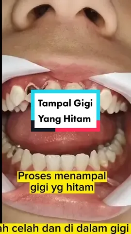 #tampalangigi #filling #klinikgiginearme 