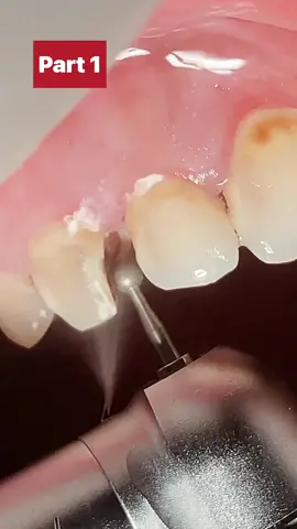 Deep caries #dental #dentista #dentistry #dentist #caries #fypシ 