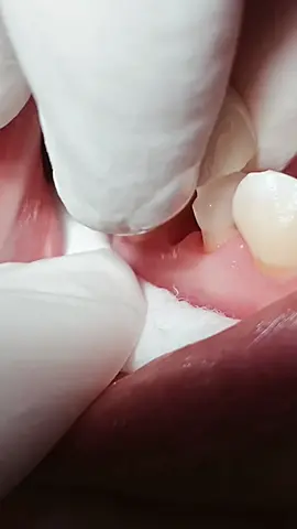 PFM bridge after root canal treatment #dentist #dental #dentistry #fypシ 