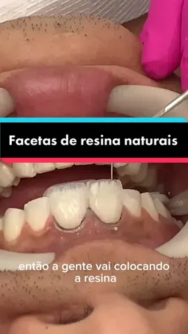 Facetas de resina em dois dentes da frente #odontologiaestetica #facetasderesina #facetasemresinacomposta #dentistry #odonto #odontologia #odontologiaestetica  