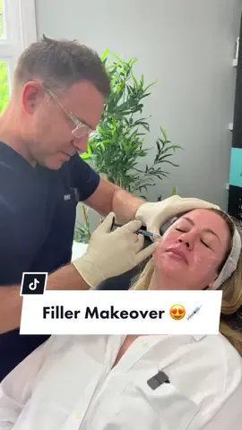 A wonderful makeover for our lovely customer 🥹💉🤍 #aestheticdoctor #filler #aesthetics #makeover 