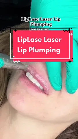 Lip Lase Laser Lip Plumping 🙌🏼 . . #noneedles #plumperlips #lips #licensedesthetician #skincaretips #skintips #skincare101 #liplase #lasertreatment #lasers #plumplips #lipplumper #fyp 