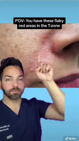 What’s on your skin? #dermdoctor A flaky, red rash by the corner of the nose, in the eyebrows, behind the ears, or in the scalp is commonly seborrheic dermatitis. It’s basically facial dandruff This is actually caused by a yeast on the skin, so we treat it with antifungal agents. Anti-dandruff shampoos and antifungal‘s are really helpful. If that doesn’t work, see your dermatologist, we have stronger medication!