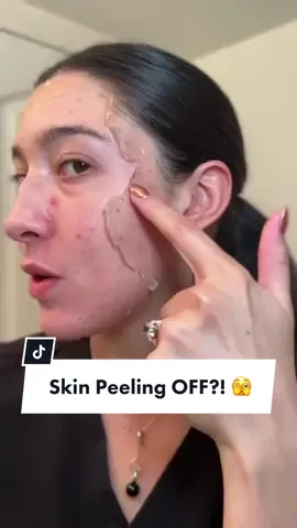 #stitch with @Annie | Acne Prone Esthetician The Perfect Peel 👀👏 #aestheticdoctor #filler #aesthetics #skinpeel #skinpeeling 