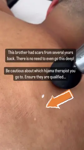 Choose your Hijama practitioner wisely! It’s important to ensure they are qualified and experienced. Here is a clear example why.. #hertscupping #HijamaPractitioner #ChooseWisely #QualifiedProfessional #ExperienceMatters #HijamaTherapy #Healthcare #HolisticHealing #WellnessJourney #FindTheRightOne #selfcaretips  #HijamaPractitioner #ChooseWisely #QualifiedProfessional #ExperienceMatters #HijamaTherapy #Healthcare #HolisticHealing #WellnessJourney #FindTheRightOne #SelfCareTips #NaturalHealing #TraditionalMedicine #HealthandWellness #QualifiedPractitioner #HijamaBenefits #AlternativeTherapy #CertifiedHijama #CarefulSelection #ExpertiseMatters #SeekQuality #hijamaexperience 