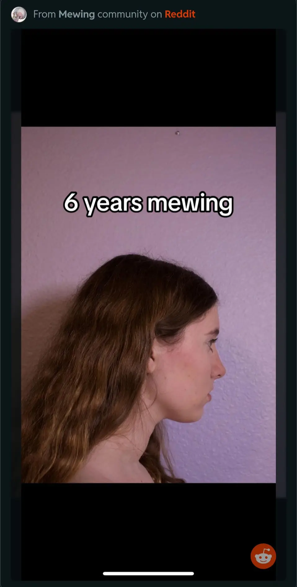 6 years mewing #fyp #mewing #jawline #mewingprogress 